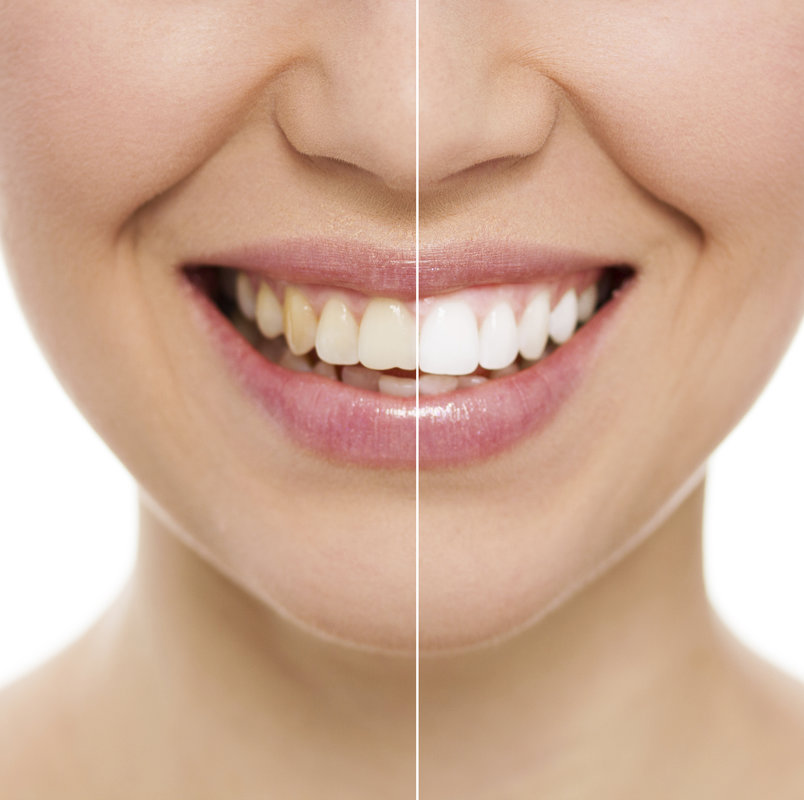 facettes dentaires avant / après